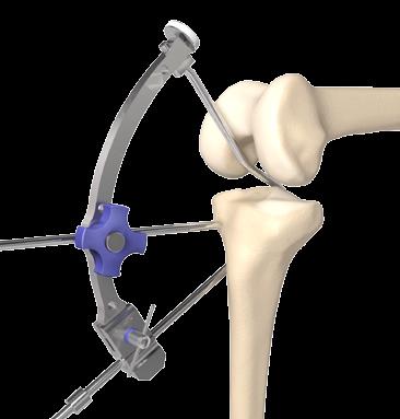Operative summary a. Tibial jig placement b.
