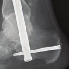 Out of the Package The Compressive Element is in its unstretched position with the calcaneal screw holes in the Sliding Element positioned proximal in the Nail Body slot.