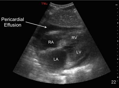 Page 3 of 10 Image 3: Subxiphoid view of a pericardial effusion. Note the liver parenchyma at the top of the screen.
