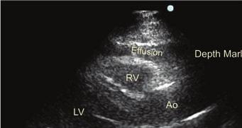 pericardial sac. In this image each line represents 1 cm.