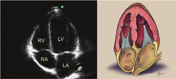 Image 13: Apical 4-chamber view of a normal heart.