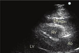 Page 8 of 10 Image 15: Parasternal view of a large, circumferential pericardial effusion.