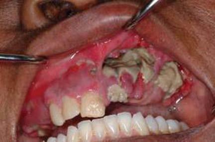 patient on po bisphosphonates > 3 years and needs dental surgery Stop 3 months before the