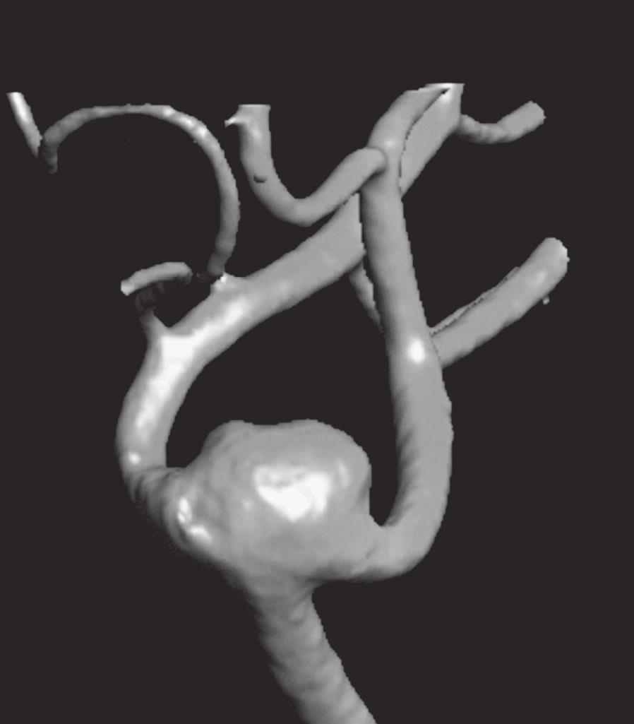 Y-Stent-Assisted Coil Embolization of Anterior Circulation Aneurysms Using Two Solitaire AB Devices... M.
