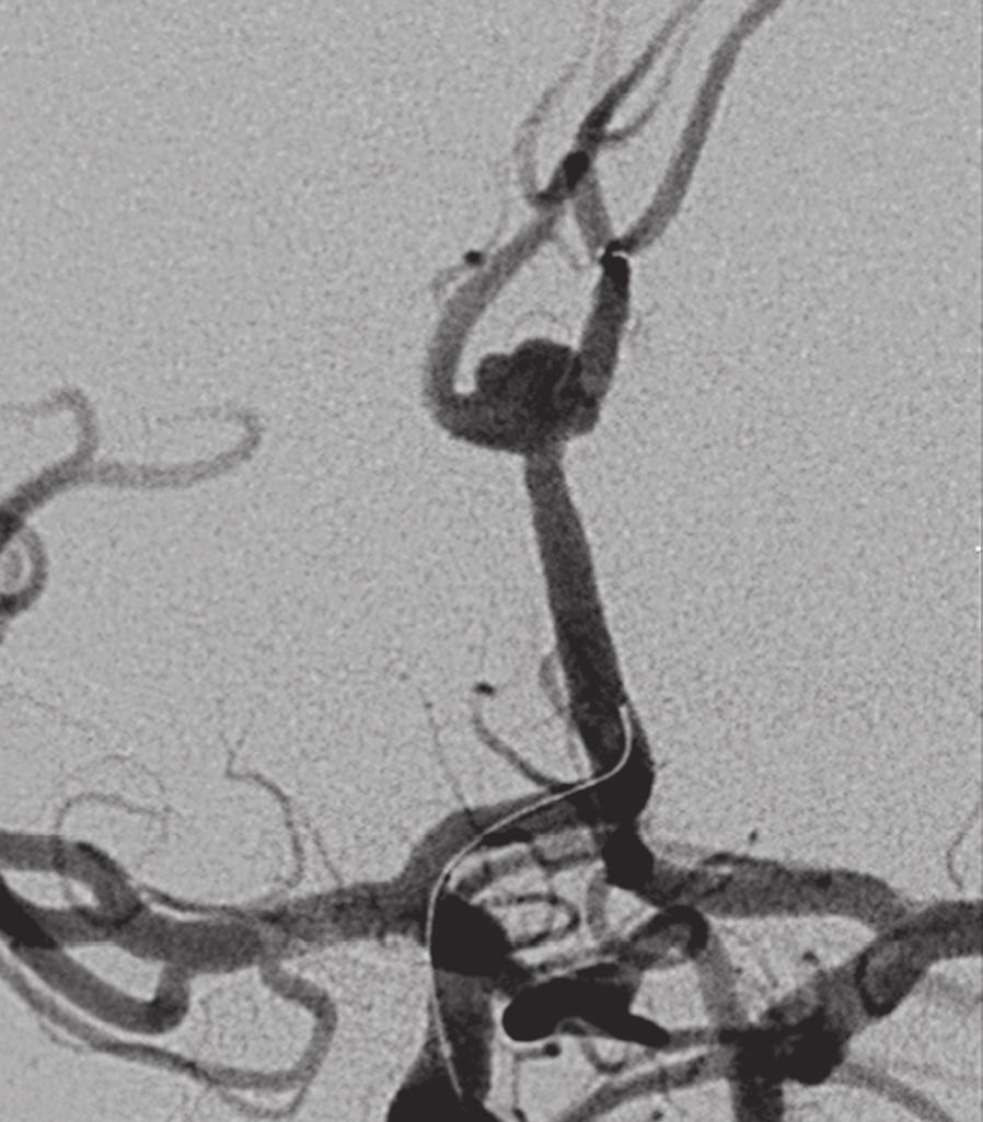 artery in a patient with an azygos anterior cerebral artery.
