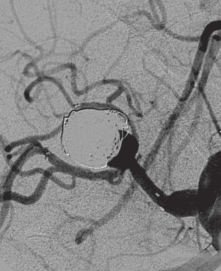 aneurysm had previously been coil embolized.