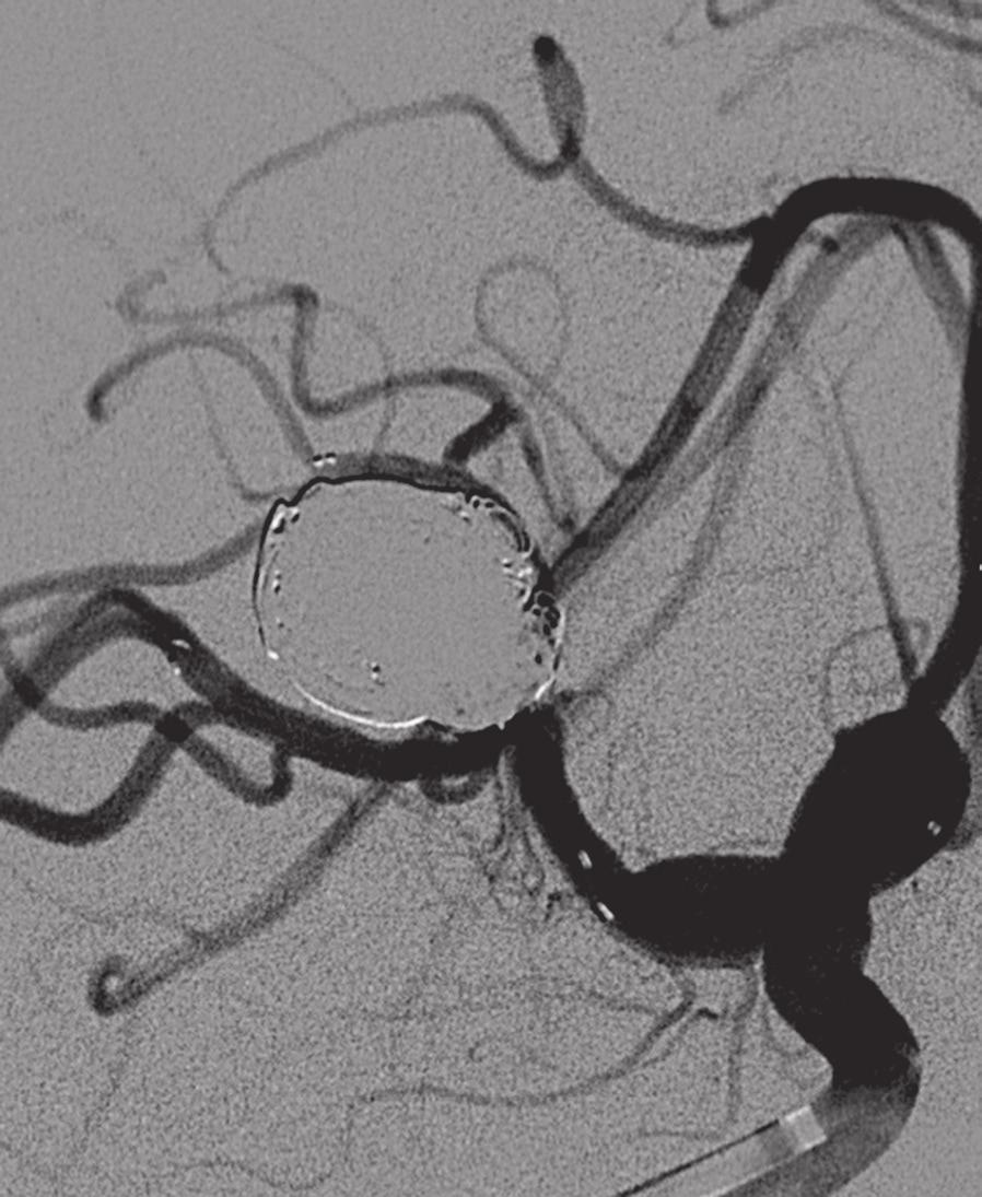 C) With the stents in place, coil embolization results in complete occlusion of the aneurysm sac.