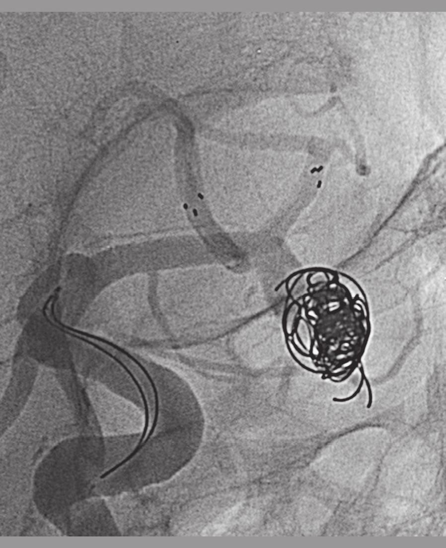 Y-Stent-Assisted Coil Embolization of Anterior Circulation Aneurysms Using Two Solitaire AB Devices... M. Martínez-Galdámez A coils migrate through the cells.