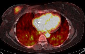 Predictive Biomarkers in Tumor Response Breast
