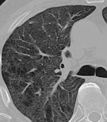 Lung Tumor: CT Screening?