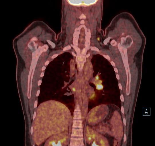 Patient case relapse CASE After 2 x ABVD a PET/CT shows residual activity in the mediastinum