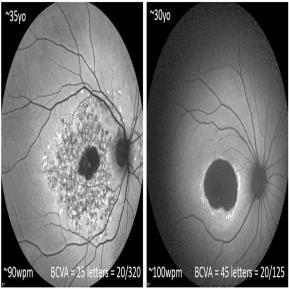 Outcome measures include best corrected visual acuity (BCVA), reading speed, and size of atrophic lesion.