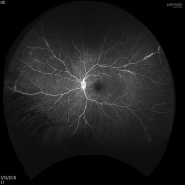 initiating fluorescein angiography studies included: signs of intraocular inflammation and vitreous cells (5/9, 56%), strong personal and familial history of autoimmune conditions (4/9, 44%), and