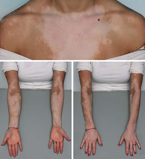 242 Fig. 1. Areas of cutaneous depigmentation (vitiligo) on the upper thorax and forearms. of Ota) [2], represents a significant risk factor for the development of uveal melanoma.