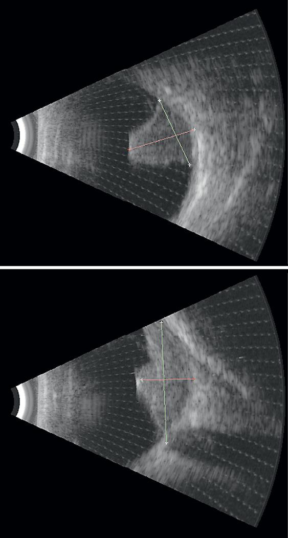 244 Fig. 3. B-mode ultrasound showing the presence of solid choroidal tumour with diffuse and cupuliform growth, base 17.88 mm and height 10.04 mm.