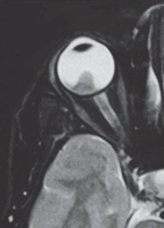 245 Fig. 4. T2-weighted orbital magnetic resonance showing the hyperintense tumour mass located on the posterior pole of the RE.