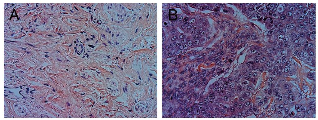 4 L. Zhang et al. Figure 1. Hematoxylin-eosin staining of breast cancer tissue (lower image) and adjacent normal tissue (upper image). Figure 2.