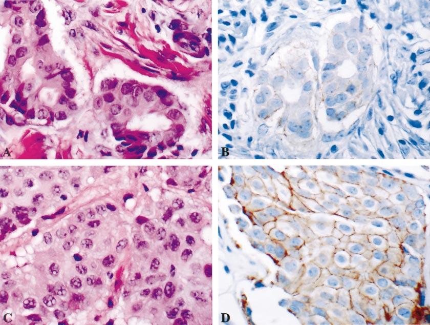 Figure 2. A through D, Case in which the immunohistochemical (IHC) image analysis scores of the primary breast carcinoma were discordant from that of the metastasis in the spinal cord dura.