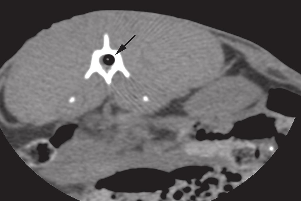 1516 ANTONIO F.B. DA FONSECA et al. Figure 4 - Tomographic image showing catheter positioning. Spinal canal with the presence of the inflated cuff (white arrow) Source: Personal archive, 2014.