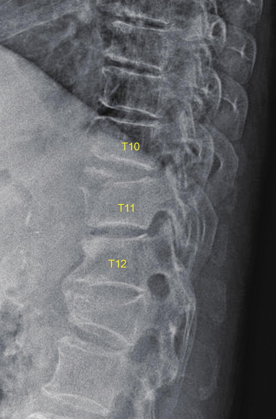 sian Spine Journal Hyperextension injury in thoracic spine 127 posterior column, which are spinous process fractures, magnetic resonance imaging (MRI) was required.