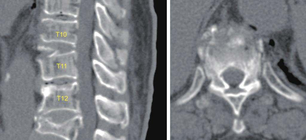 Hemorrhage within the disc was also seen at the T10 to T11 space. The posterior column including spinous process and interspinous ligament had high signal intensity on T2-weight MRI.