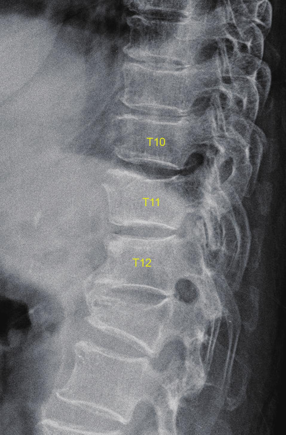 The fracture was not more displaced compared to previous imaging, but the intervertebral disc of T10 to T11 space was extruded with superior migration, compressing the spinal cord with compressive