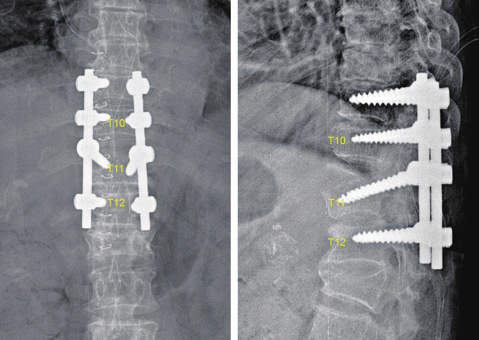 130 Dong-Eun Shin et al. mechanism of this spinal cord injury was traction rather than compression.