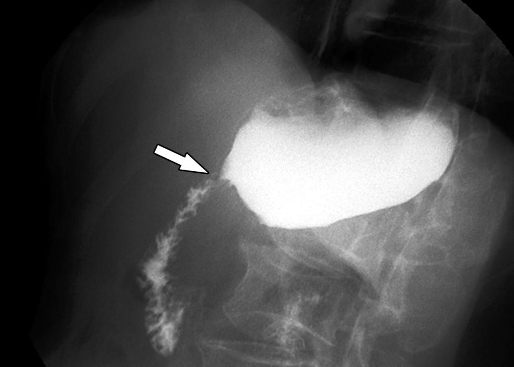 alloon ilatation for enign nastomotic Stricture in UGI Tract during the