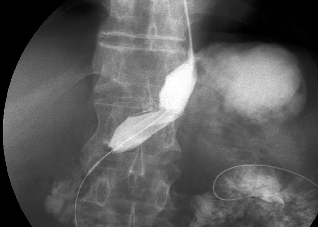Fluoroscopically guided balloon dilation for anastomotic stricture at