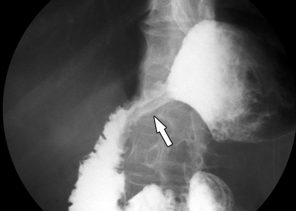 Kim et al. F G Fig. 1. Fluoroscopically guided balloon dilation for anastomotic stricture at gastroduodenostomy. F, G.