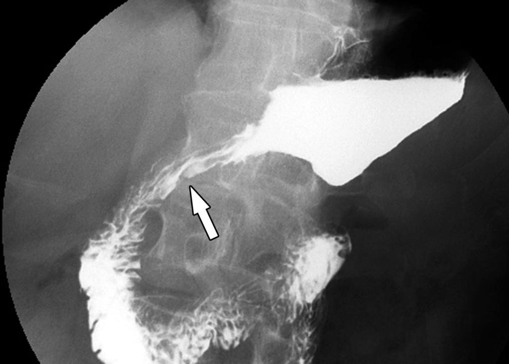 In cases of a stricture at gastrojejunostomies, some investigators have targeted a desirable luminal diameter of 15 mm (9, 10).