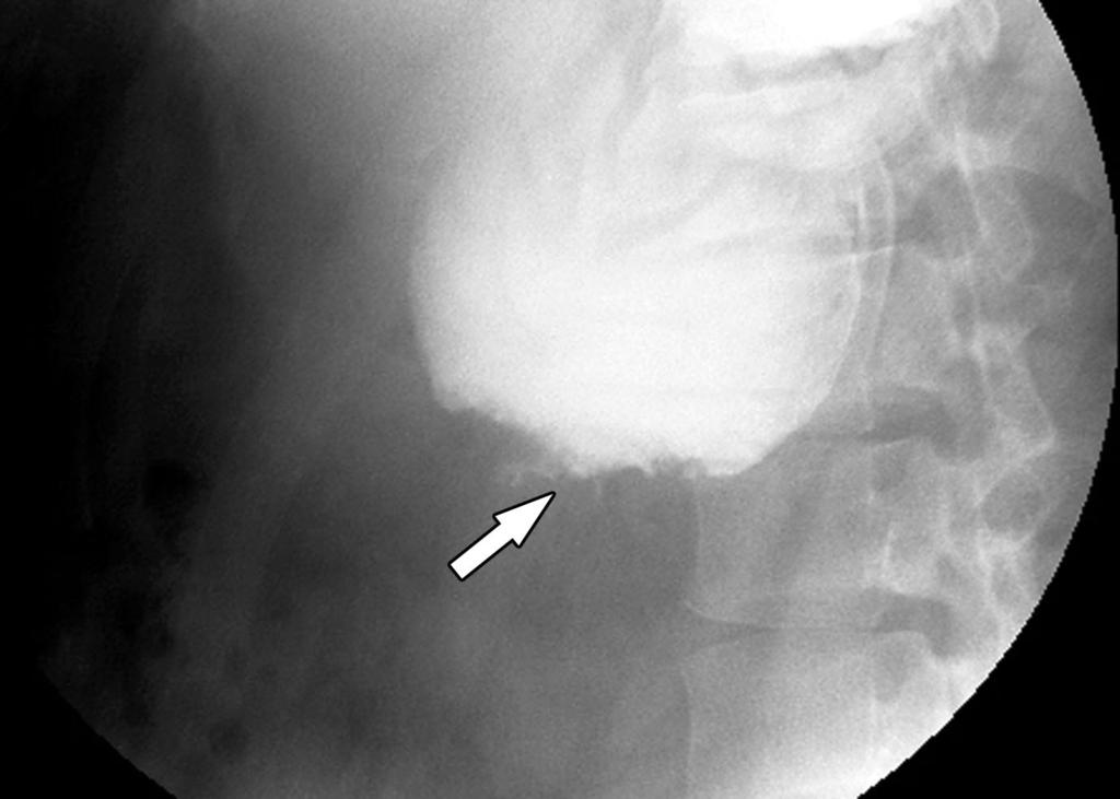 alloon ilatation for enign nastomotic Stricture in UGI Tract after gastric surgery; these strictures can lead to prolonged vomiting and nutritional deficiencies (15).