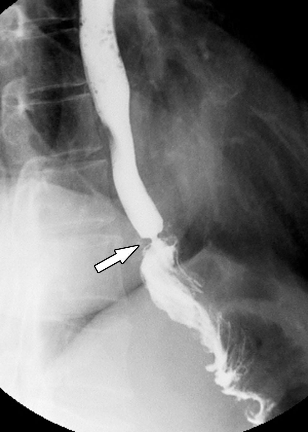 Kim et al. Fig. 3. Fluoroscopically guided balloon dilation for anastomotic stricture at esophagojejunostomy.
