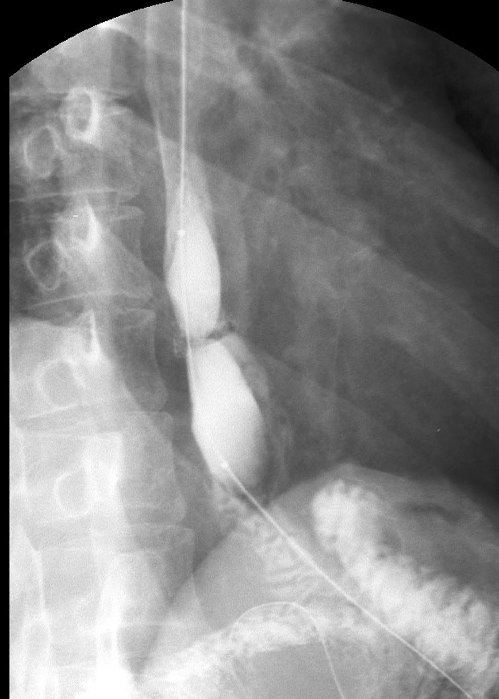 20-mm-diameter balloon is placed and is inflated until waist forms by stricture disappeared.. Immediately after balloon dilation, stricture is greatly improved (arrow).