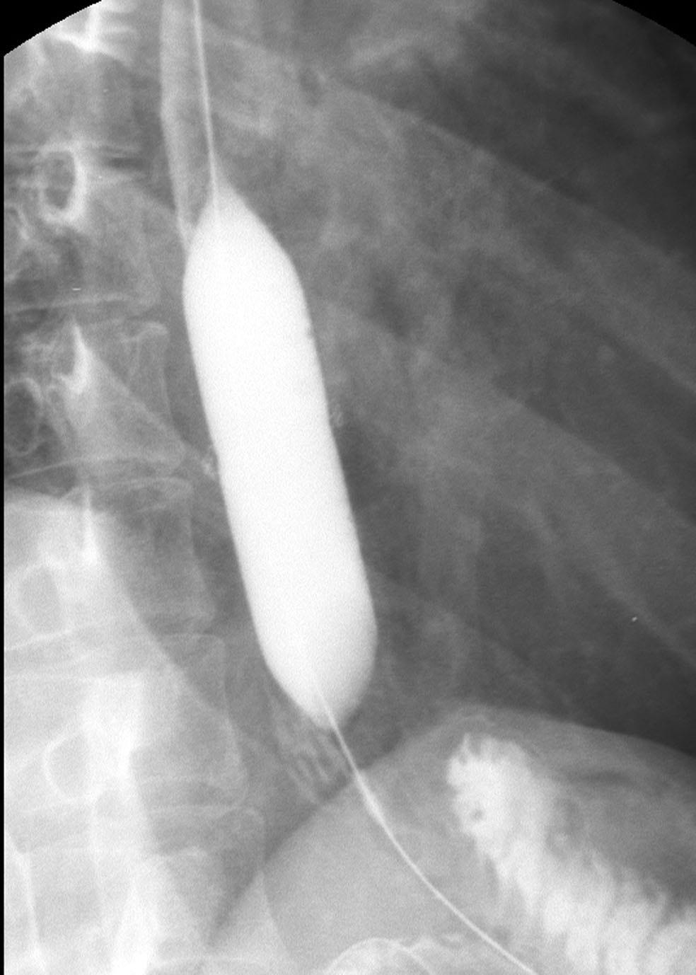 In one series (14), all 25 children with anastomotic strictures secondary to surgical repair of esophageal atresia, experienced symptom improvement following FG over a follow-up period from