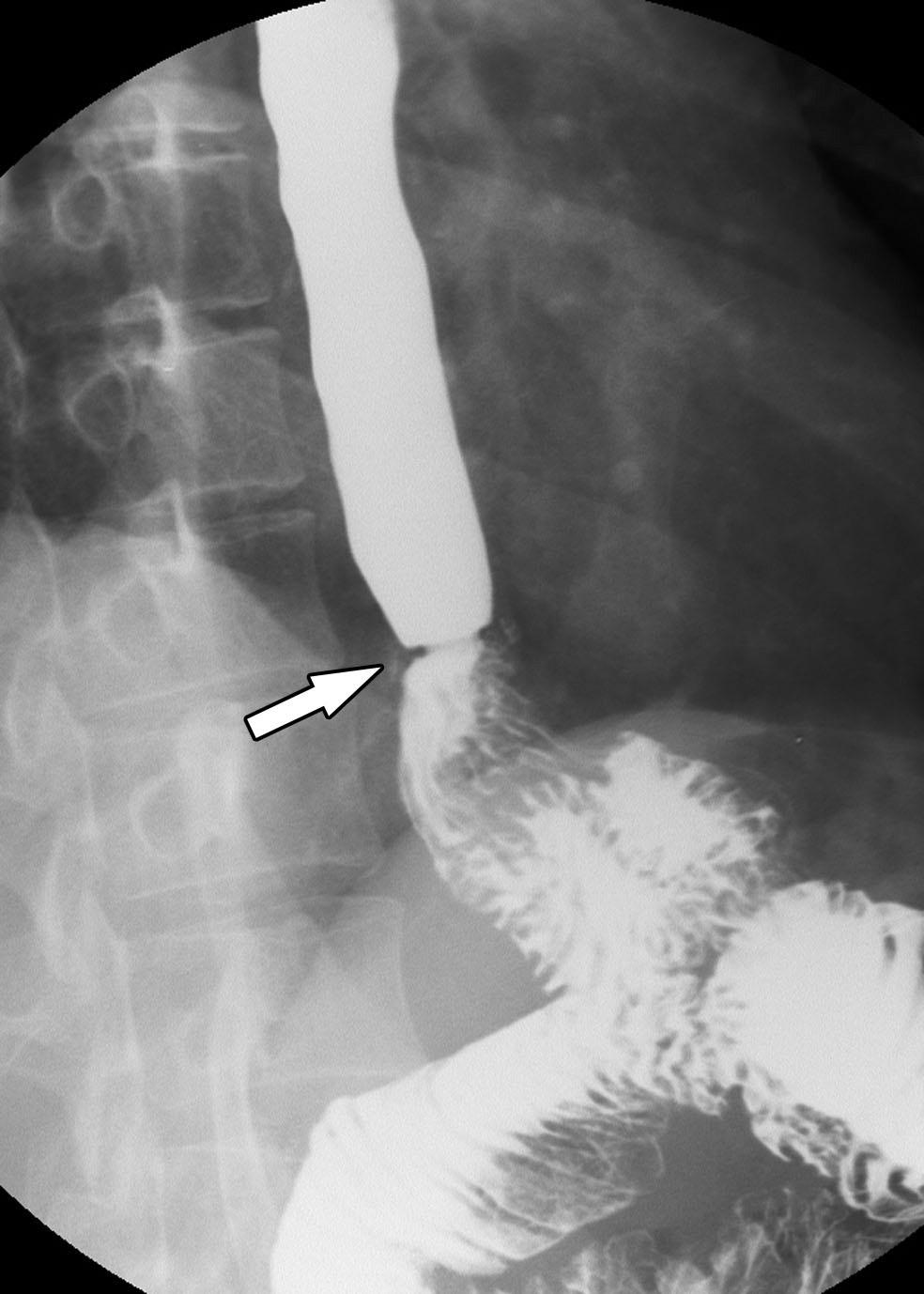 In another series (3), FG obstructive symptoms were relieved in 93% (27/29) of patients with strictures following surgical repair of esophageal atresia, during a mean follow-up period of