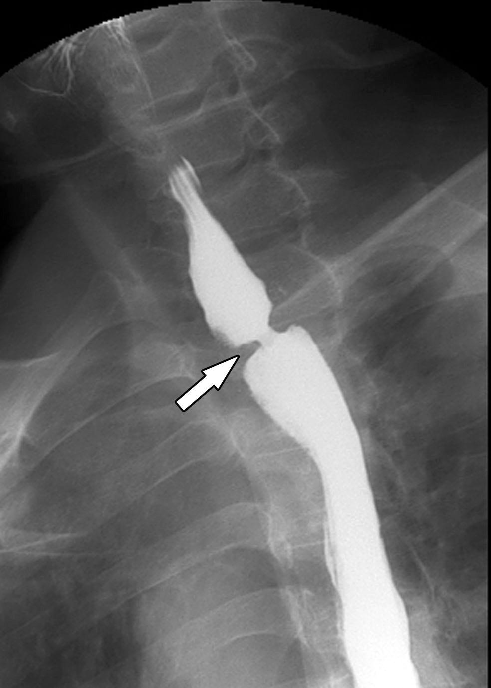 alloon ilatation for enign nastomotic Stricture in UGI Tract Fig. 4. Fluoroscopically guided balloon dilation for anastomotic stricture after Ivor-Lewis surgery.
