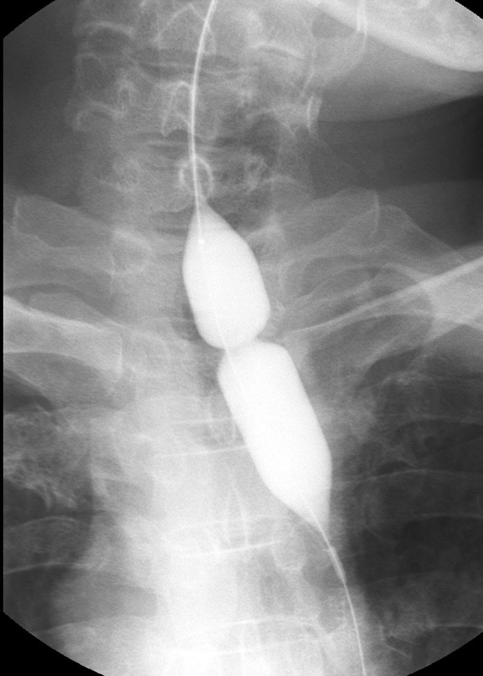 20-mm-diameter balloon is placed and is inflated until waist forms by stricture disappeared.
