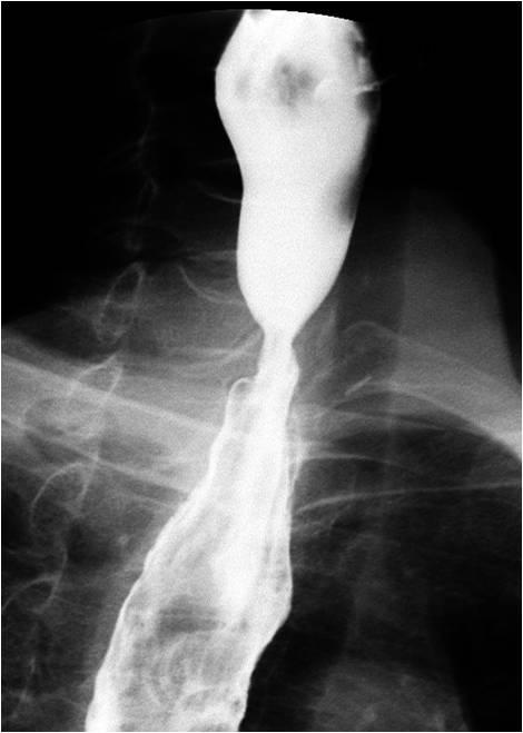ONLUSION benign anastomotic stricture is a common complication after gastric or esophageal surgery.