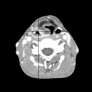 CT MRI (T2)