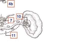 gastric, celiac and splenic arteries (stations 1-11) D3 is a superextended