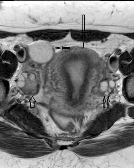 structure in the right adnexa (short arrow) which is oriented vertically lateral to the uterus (long arrow) Fig III: 51 year