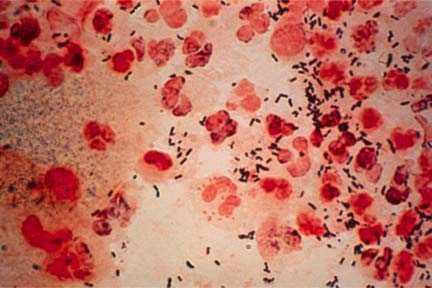 4 million Neisseria gonorrhea Worldwide Cases (2008) Prevalence: 106.
