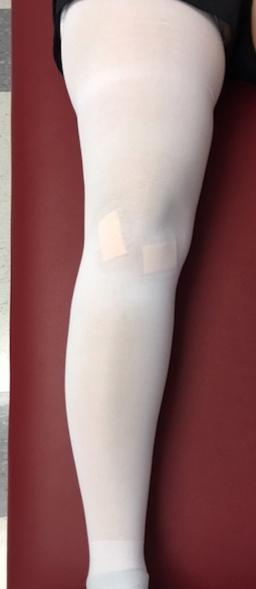 Examples of compression (TED hose) with adhesive postoperative dressings: 2) After three days you may change the dressing using 4x4 inch gauze and ACE wrap (4