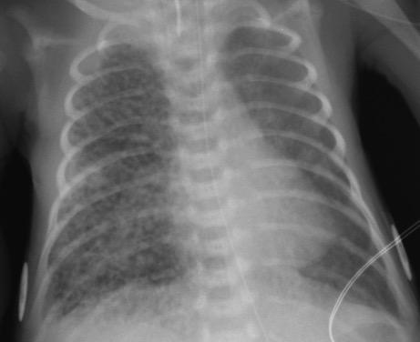 Unilateral cystic lung