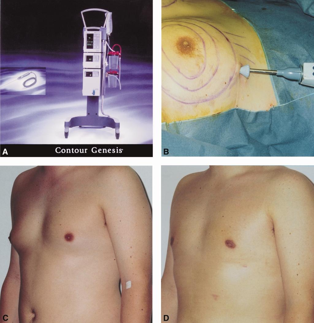 A systematic approach to the surgical treatment of gynaecomastia 239 Figure 2 (A) Contour Genesis machine. (B) Intraoperative view of the probe in situ with skin protector.