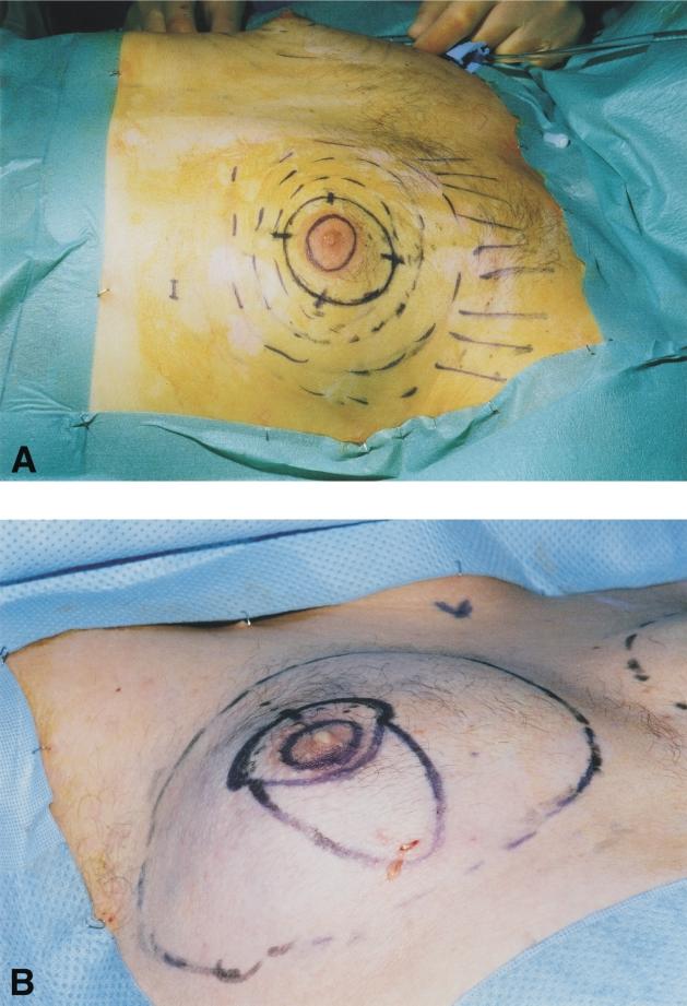 240 British Journal of Plastic Surgery gynaecomastia. In total, 48 breasts were surgically treated. The majority of the breasts treated were assessed as small to moderate (Table 1).