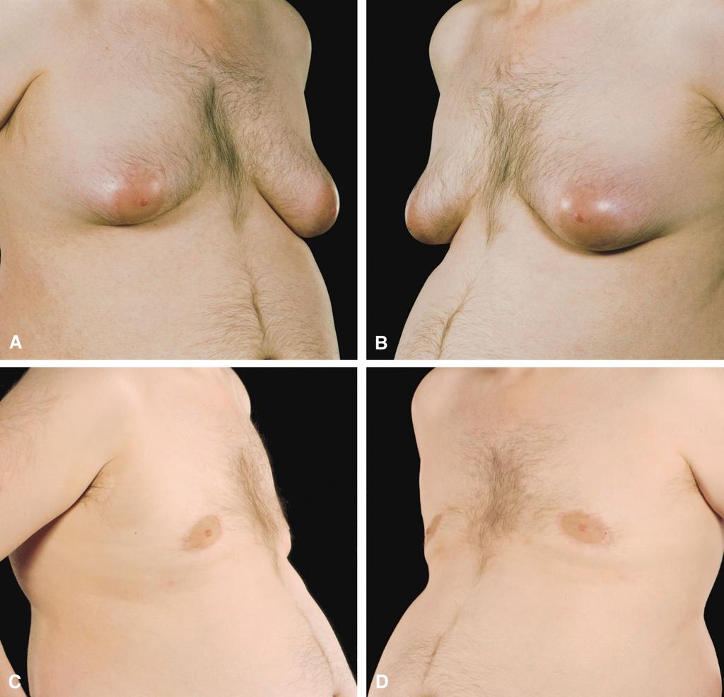 A systematic approach to the surgical treatment of gynaecomastia 241 Figure 5 A 47-year-old patient with moderate-to-large breasts treated by suction-assisted liposuction and concentric mastopexy.
