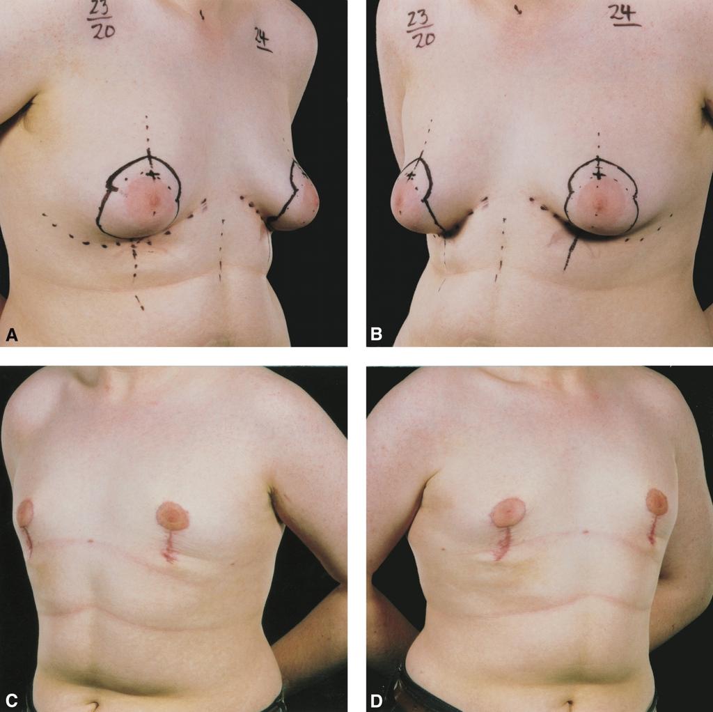 242 British Journal of Plastic Surgery Figure 6 A 17-year-old patient with moderate-to-large breasts treated by suction-assisted liposuction, open excision and Lejour mastopexy.
