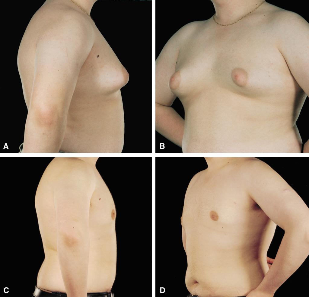244 British Journal of Plastic Surgery LeJour has popularised a vertical mammaplasty technique without submammary scar for mastopexy and reduction of the female breast.
